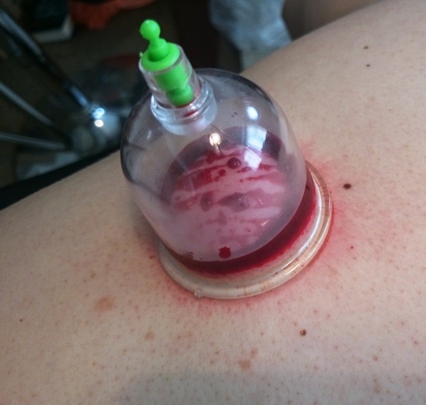 blood cupping 